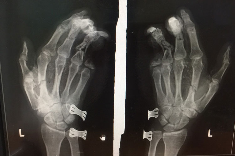 Hình ảnh phim X-Quang cho thấy ngón tay út trên bàn tay trái của anh D. bị cụt mất 2 đốt sau vụ nổ điện thoại